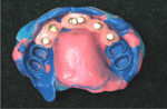 Implantatgetragene Versorgung festsitzend