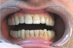 Implantatgetragene Versorgung bedingt herausnehmbar