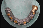 Implantatgetragene Versorgung bedingt herausnehmbar