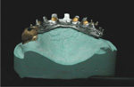 Implantatgetragene Versorgung bedingt herausnehmbar