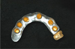 Implantatgetragene Versorgung bedingt herausnehmbar